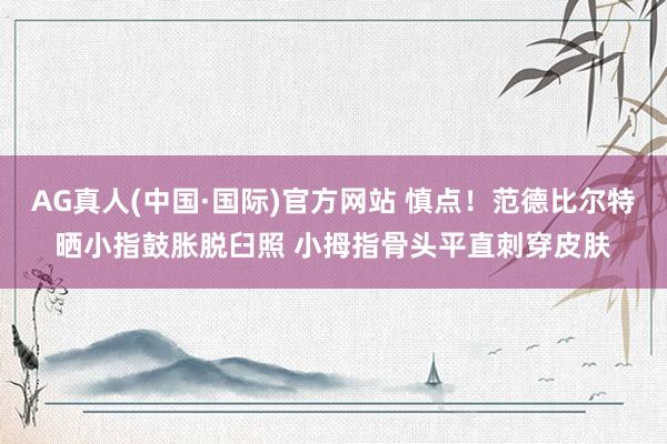 AG真人(中国·国际)官方网站 慎点!范德比尔特晒小指鼓胀脱臼照 小拇指骨头平直刺穿皮肤